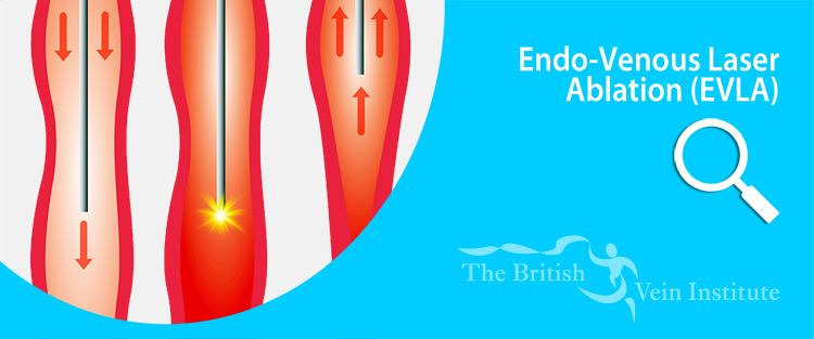 endo venous laser ablation EVLA - British Vein Institute